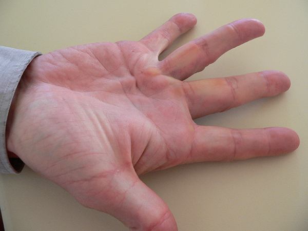 Supporting Image for article Dupuytren's Contracture