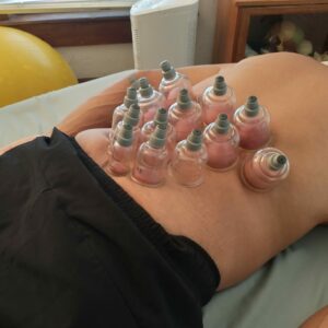 Cupping technique